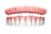 Implant denture