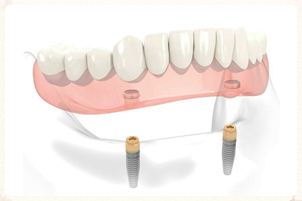 locator denture